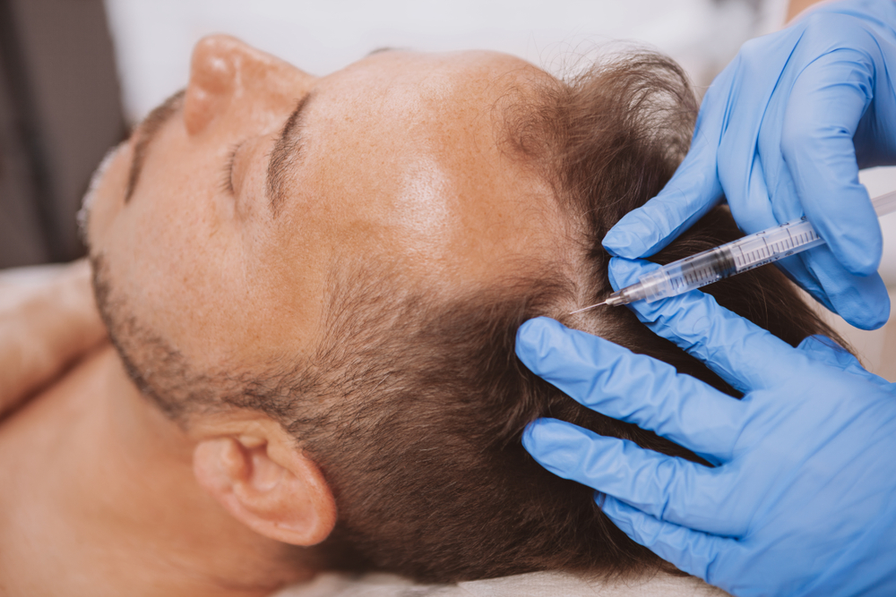 PRP ( Platelet-Rich-Plasma) Tedavisi